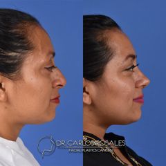 Antes y después de Rinoplastia