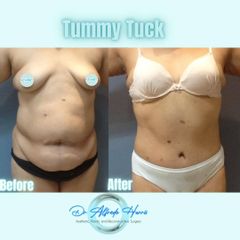 Abdominoplastia - Dr. Alfredo Harris Dominguez
