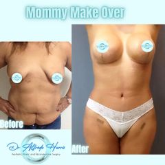 Mommy Makeover - Dr. Alfredo Harris Dominguez