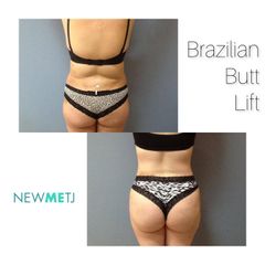 Gluteoplastia - Dr. Alfredo Harris Dominguez