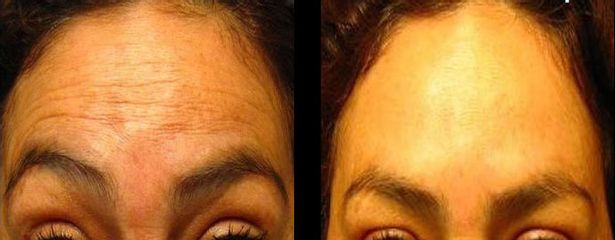 Antes y después de rejuvenecimiento facial 