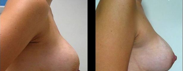 Antes y después de aumento de busto