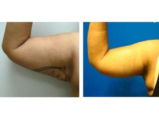 Antes y después de Braquioplastia