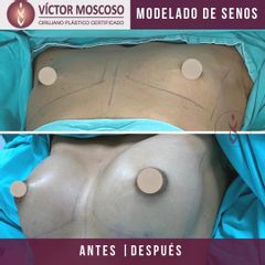 Antes y después de Aumento de busto 