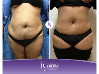 Antes y después de abdominoplastia