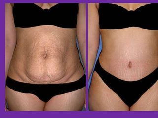 Antes y despues de abdominoplastia