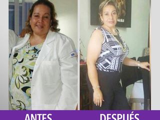 Antes y despues de abdominoplastia