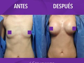 Antes y despues de aumento de senos