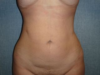 Resultado de Liposucción