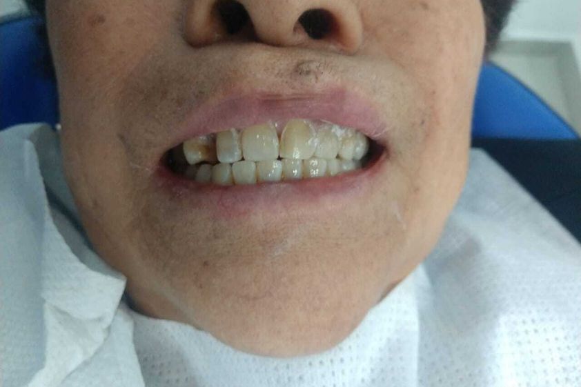 Blanqueamiento Dental antes y después - 689795