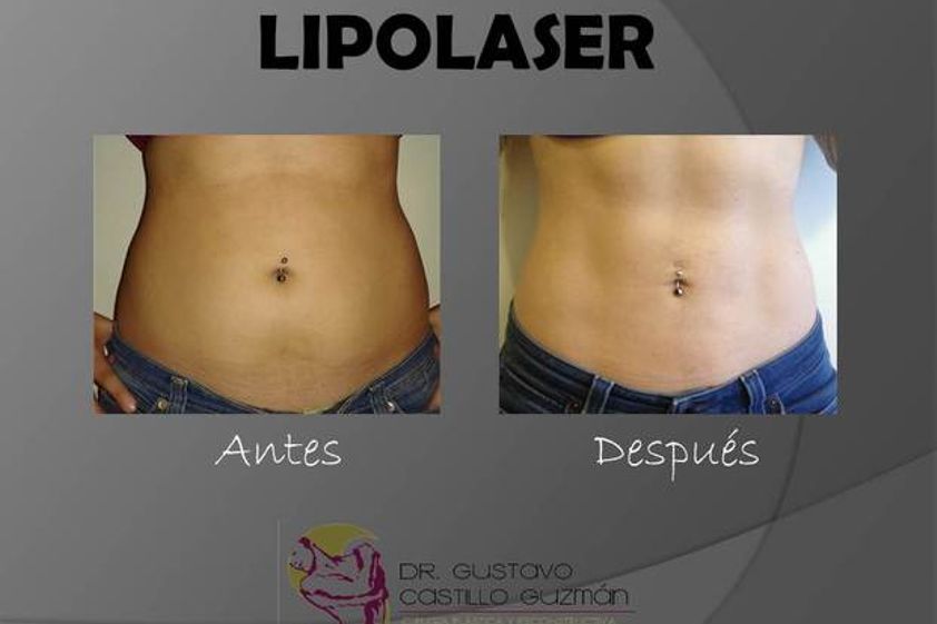 Lipólisis antes y después - 550110