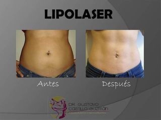 Antes y después de Lipolaser