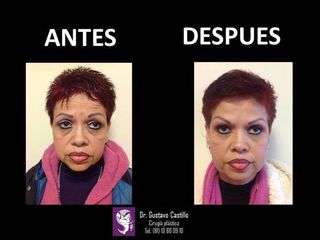 Antes y después de rejuvenecimiento facial sin cirugia