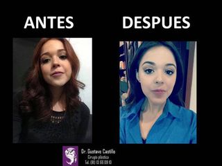 Antes y despues de bichectomia