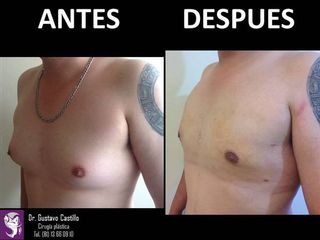 Antes y despues de ginecomastia