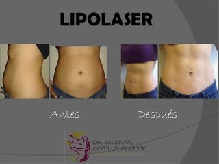 Antes y despues de lipoláser