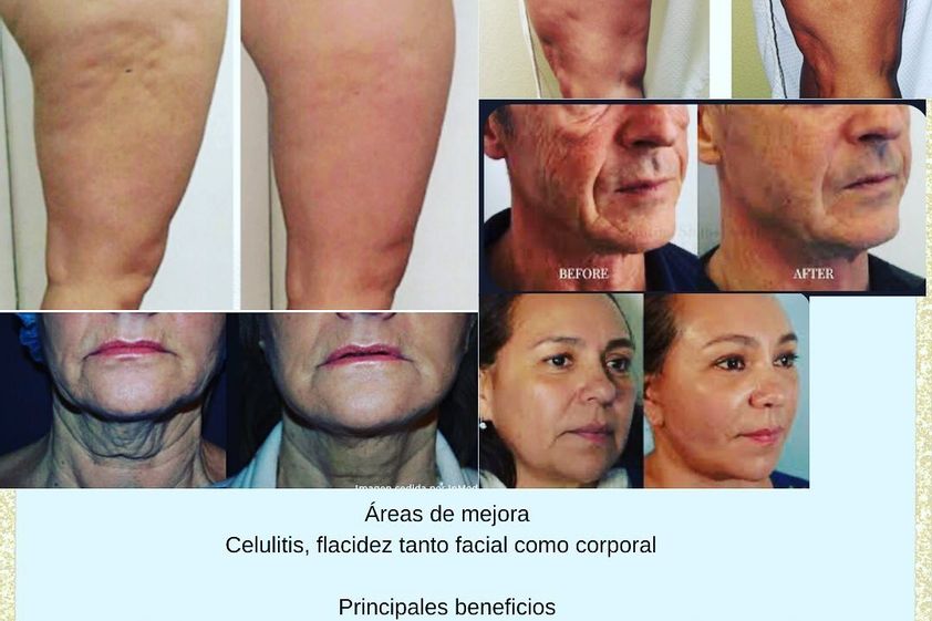 Drenaje linfático antes y después - 850697
