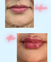 Aumento de labios - Joyas Clinique Spa