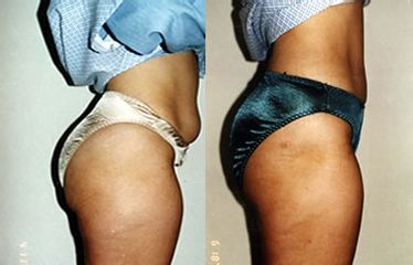 Antes y después de Gluteorplastía