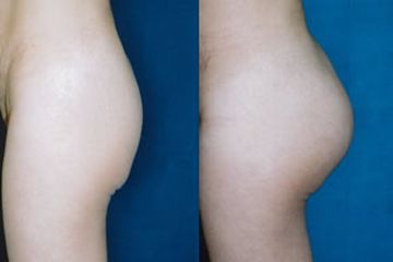 Antes y después de Gluteoplastía