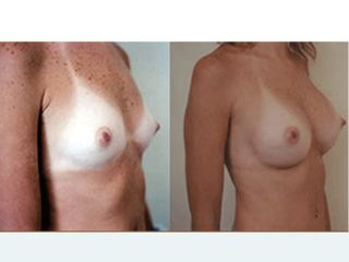 Antes y después de Aumento de pecho