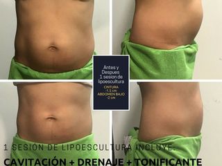 Antes y después de Lipoescultura sin cirugía
