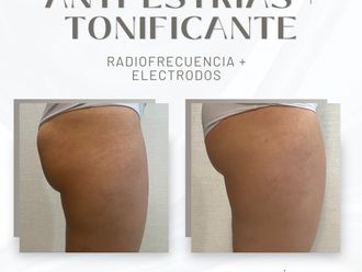 Radiofrecuencia antes y después - 855626