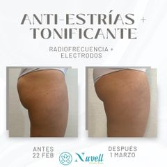 Radiofrecuencia - Nuvell Mty