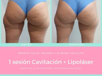 Cavitación antes y después - 855628