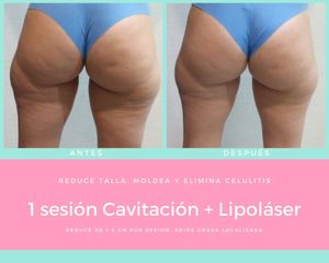 Cavitación - Nuvell Mty