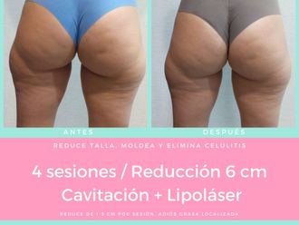 Cavitación antes y después - 855631