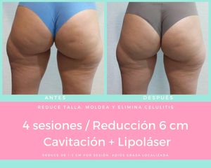 Cavitación - Nuvell Mty