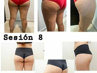 Radiofrecuencia antes y después - 855632
