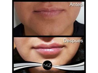 Antes y después aumento de labios