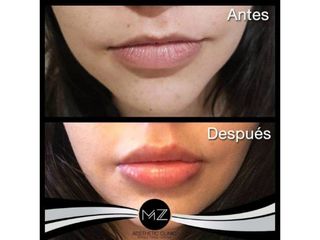 Antes y después aumento de labios