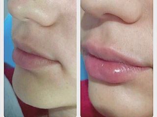 Antes y después de un aumento de Labios