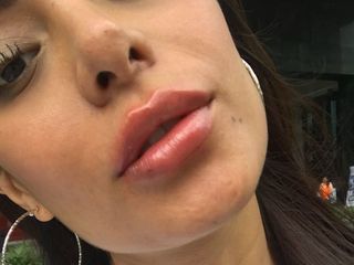 Resultados de un aumento de labios