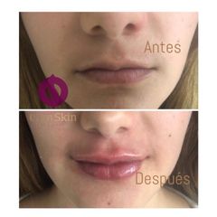 Antes y después aumento de labios