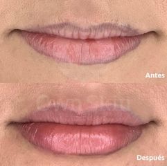 Antes y después aumento de labios