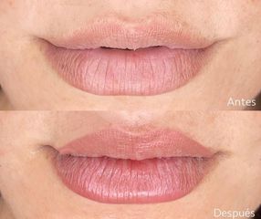 Antes y después aumento de labios