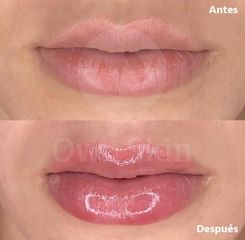 Antes y después aumento de labios