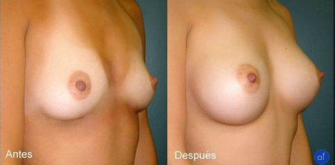 Antes y después de un Aumento de Busto