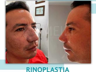 Rinoplastia antes y después - 871335