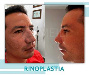 Rinoplastia - Clinica Meili