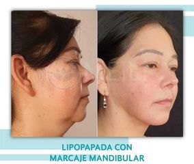 Lipopapada - Clinica Meili