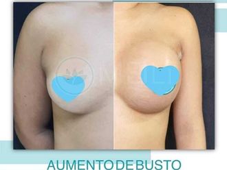 Aumento de busto antes y después - 871339