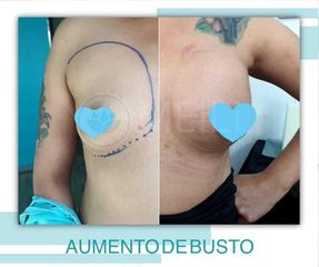 Aumento de Busto - Clinica Meili