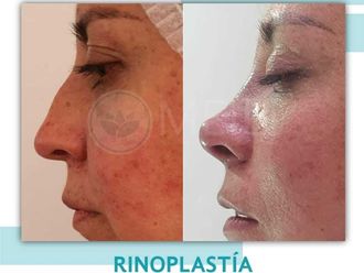 Rinoplastia antes y después - 871341