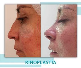 Rinoplastia - Clinica Meili