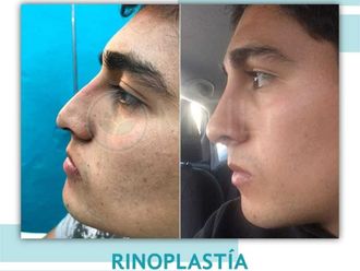 Rinoplastia antes y después - 871342